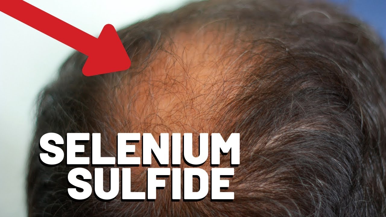 Selenium Sulfide and Hair Loss