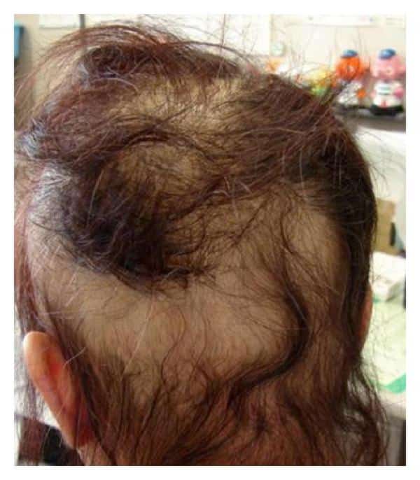 Severe Hair Loss of the Scalp due to a Hair Dye Containing Para ...