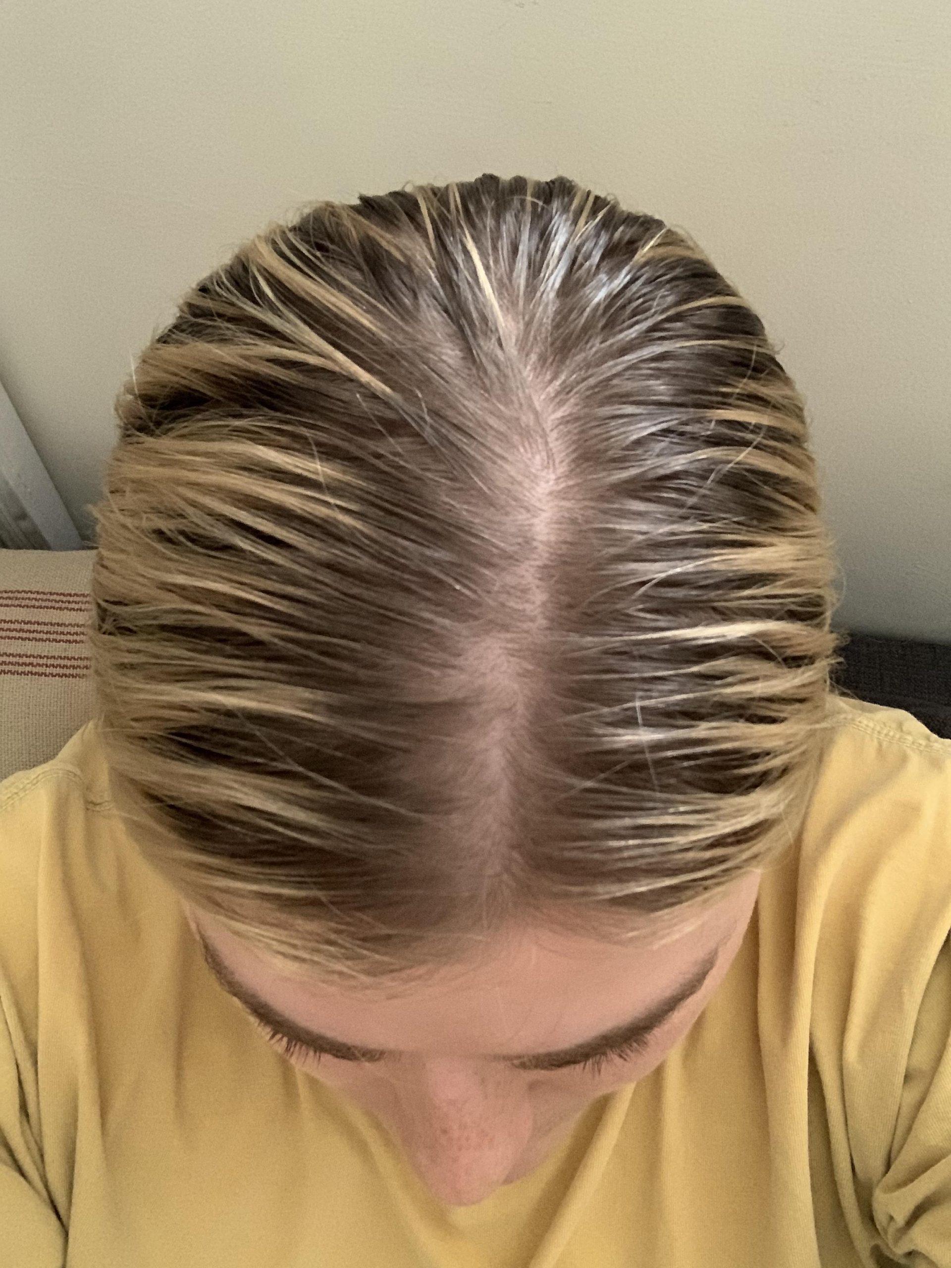 Should I be concerned about this hair loss/thinning ...