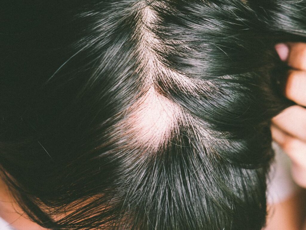 Sores on Scalp Causes, with Hair Loss and Treatments ...