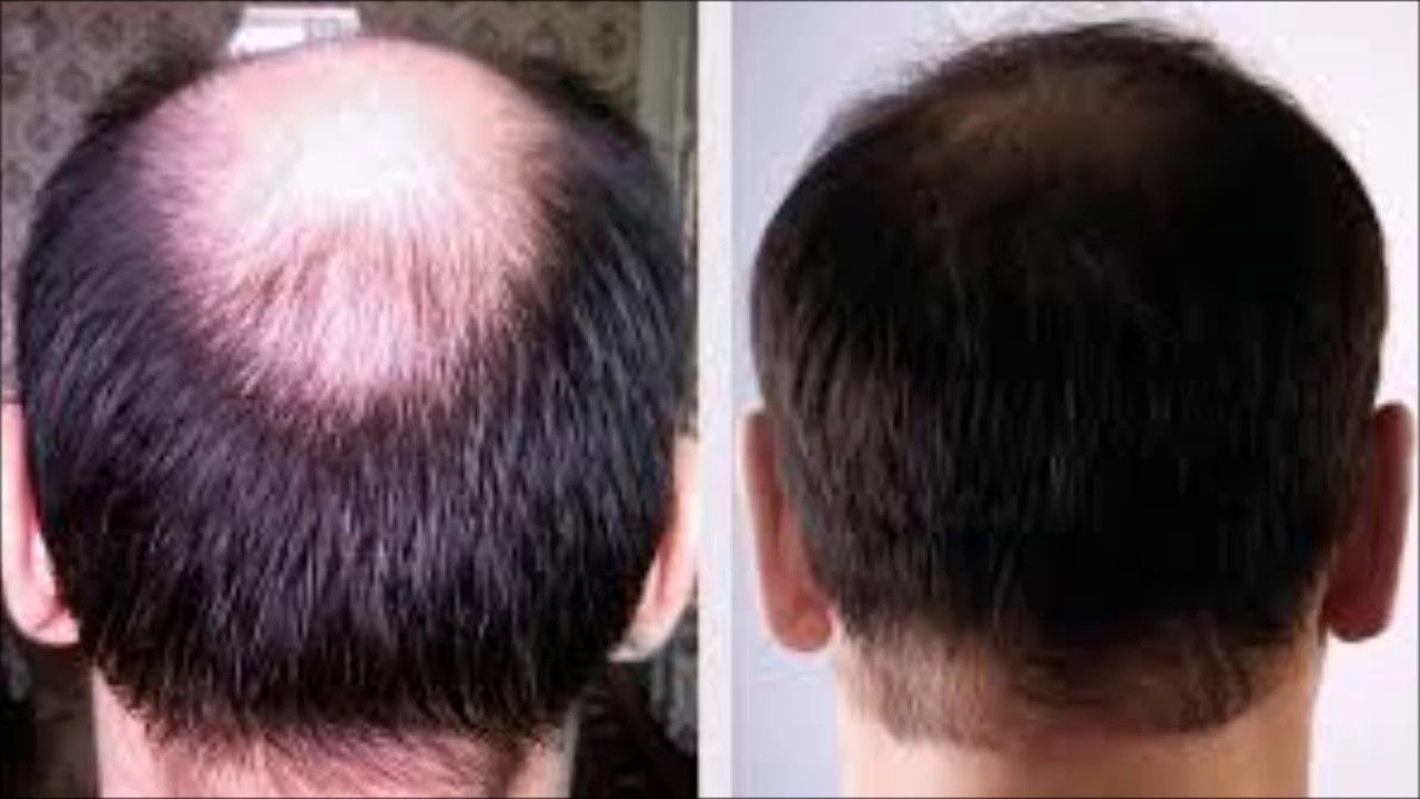 Stop Hair Loss Dht Blocker https://www.hairlossmenwomen ...