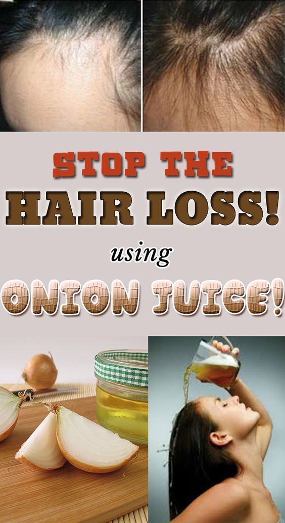 Stop the hair loss using onion juice!