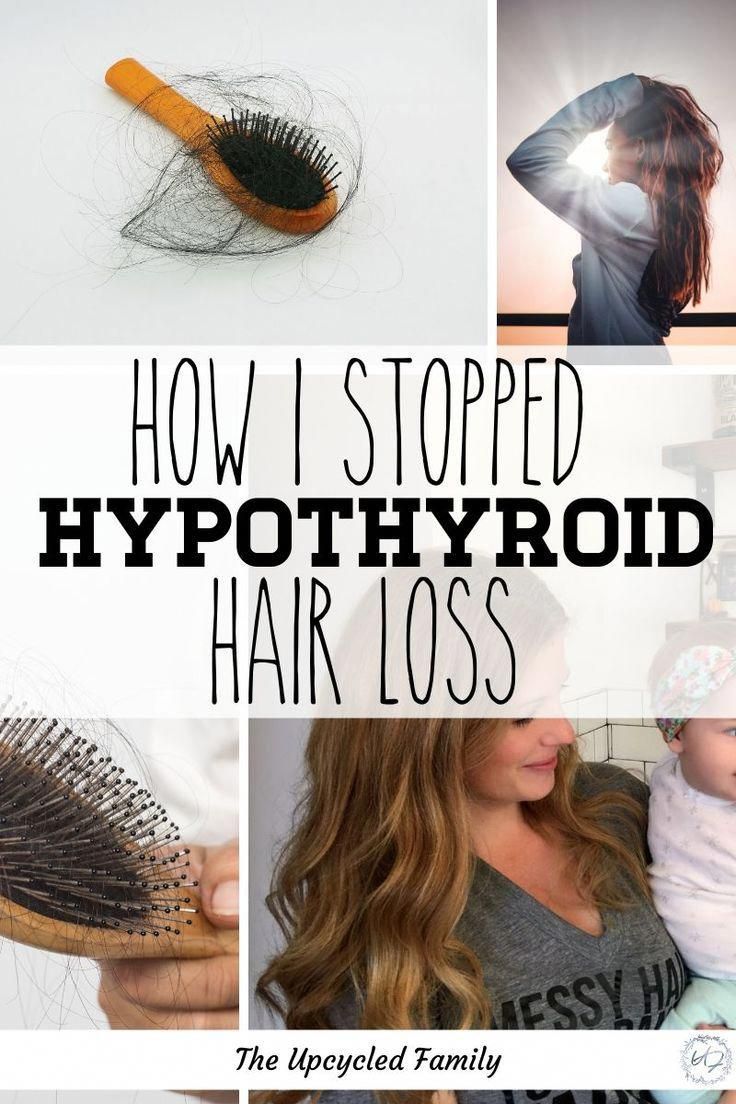 Suffering from Hypothyroid Hair Loss? in 2020