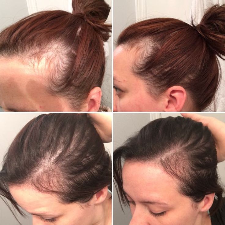 Suffering from postpartum hair loss after baby? Monat can ...