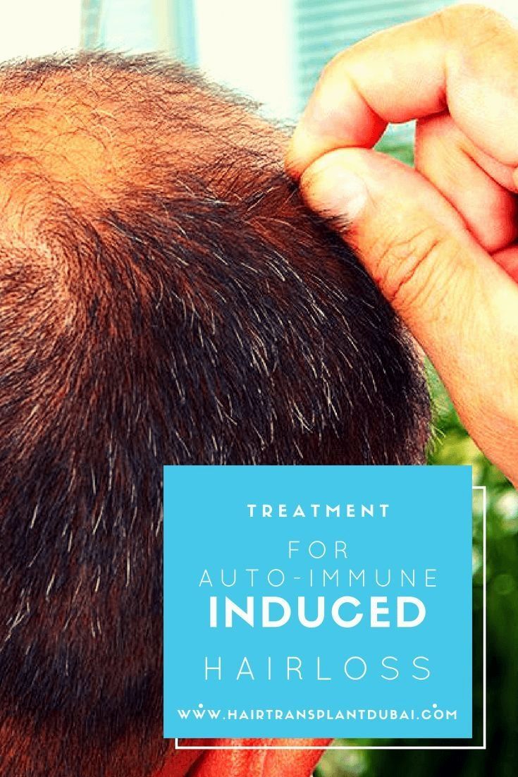 The autoimmune disorder is one of the main factors causing hair loss in ...