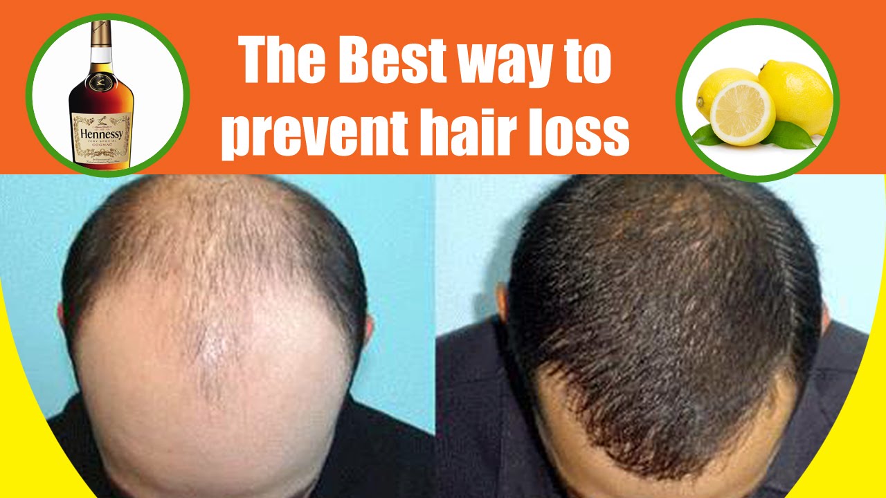 The Best way to prevent hair loss