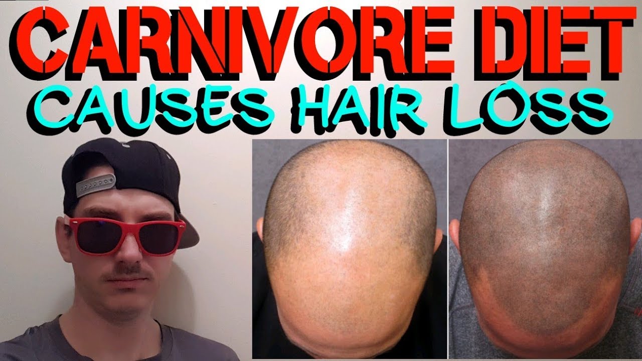THE CARNIVORE DIET CAUSES HAIR LOSS