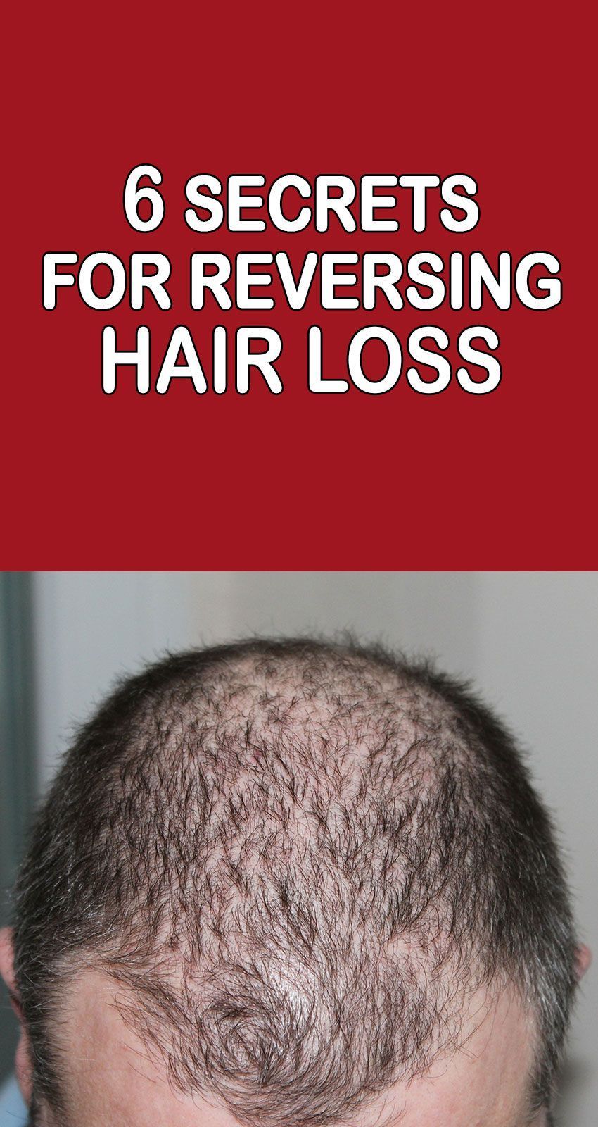 The cause of hair loss is linked to an increase in an androgen hormone ...