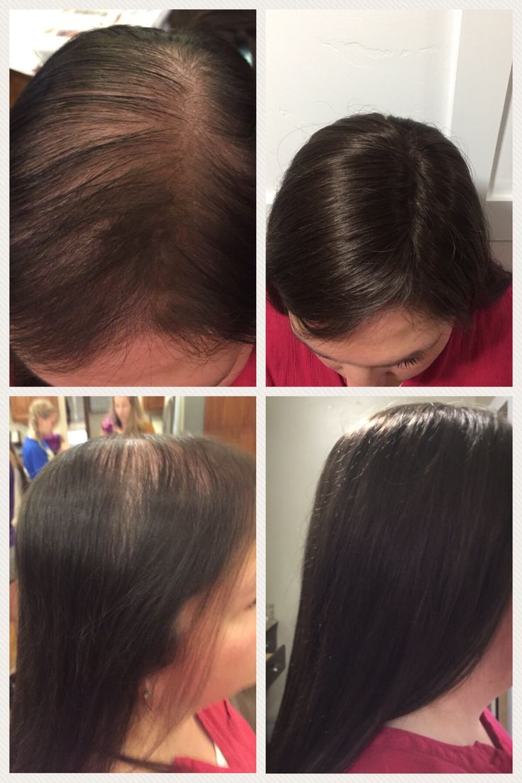 The Fall helps thinning top hair look so much thicker  ...