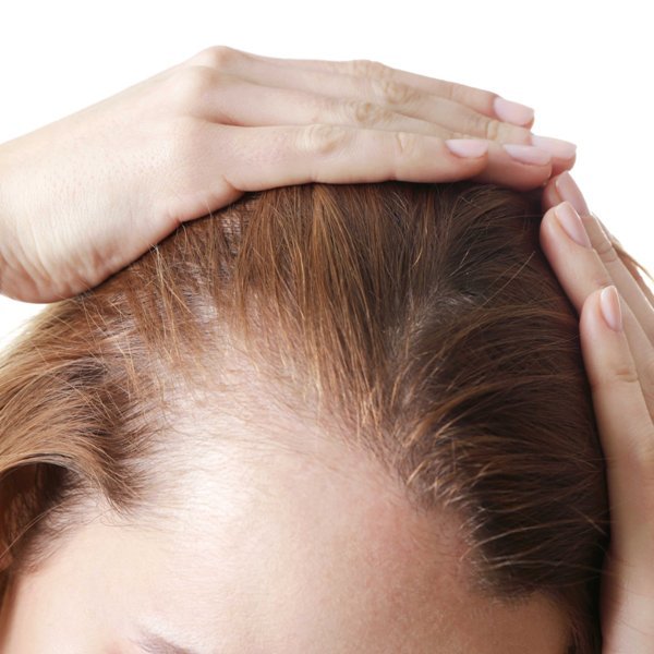 The Main Reasons for Hair Loss In Women