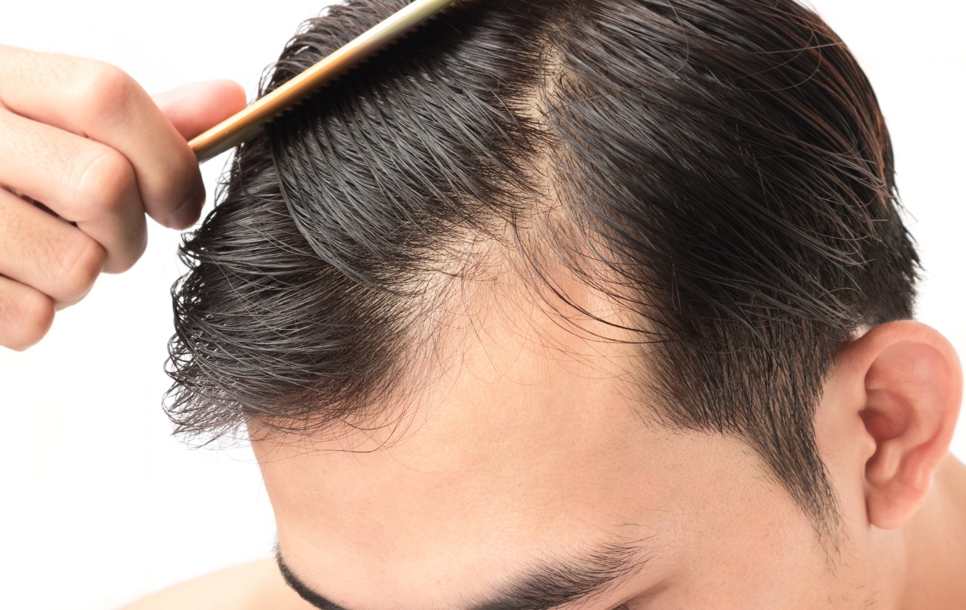 The Relationship Between DHT &  Hair Loss