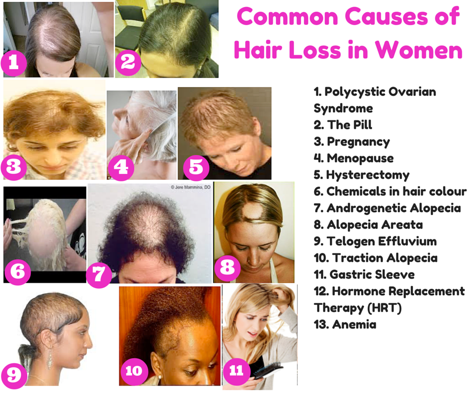 The Top 10 Causes of Hair Loss in Women, and What you Can ...