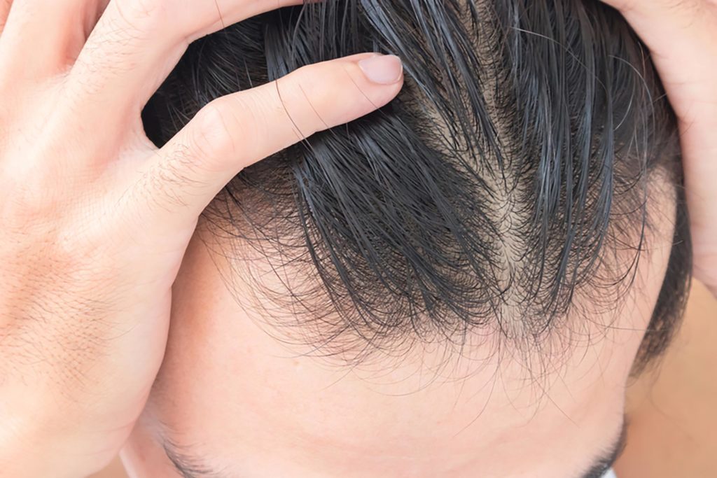 Thinning Hair: A Surprising Common Cause of Thinning Hair