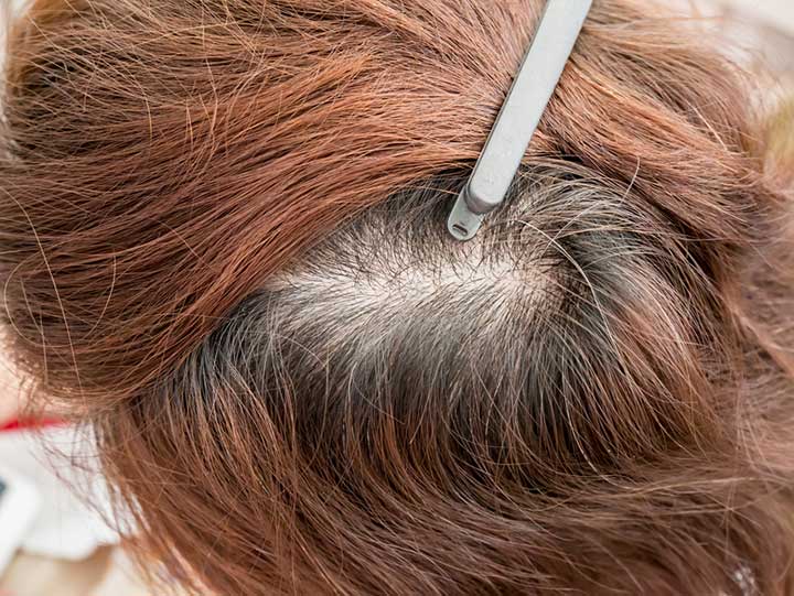 Thinning Hair Can Have Myriad Causes