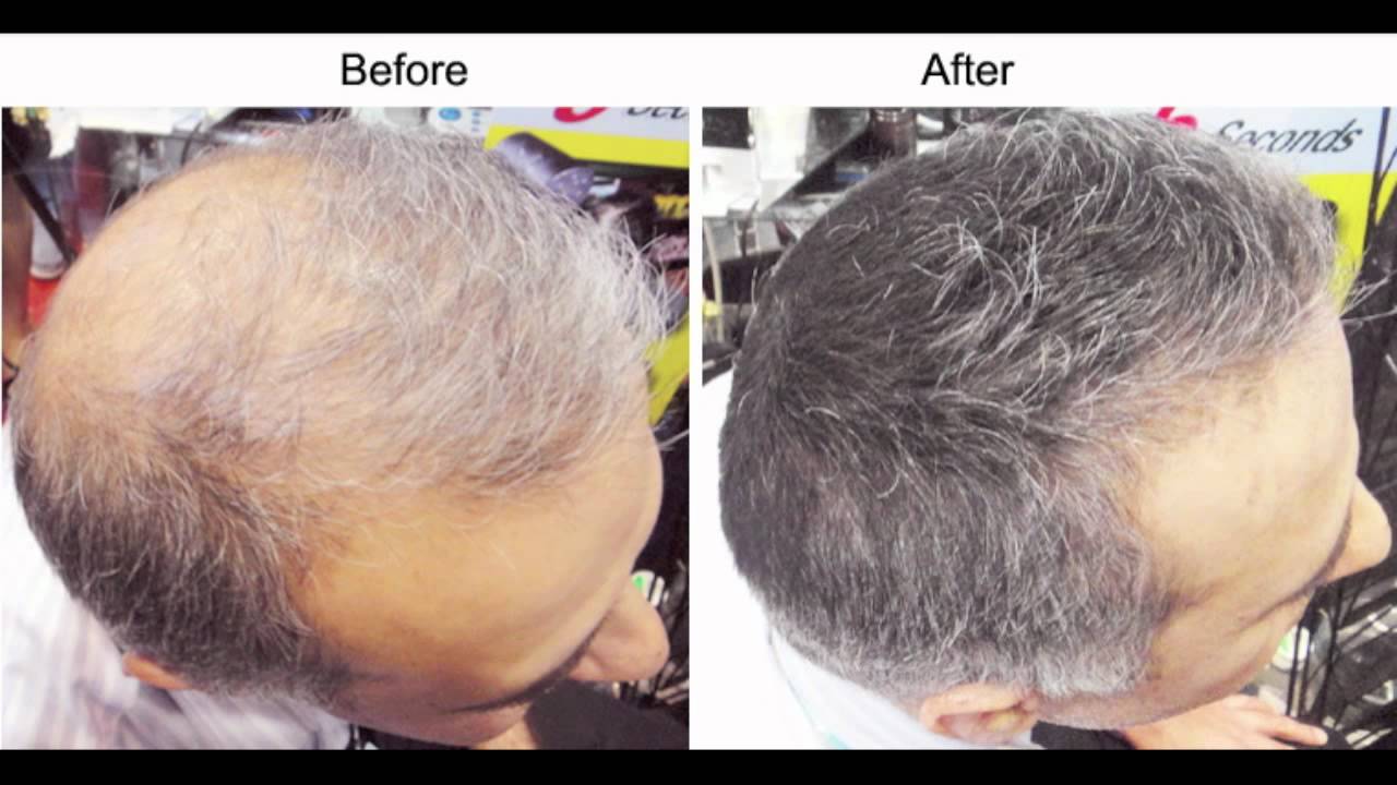 Thinning of Hair Throughout the Scalp