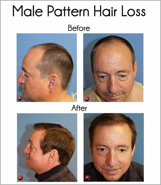 Thyroid Hair Loss Vs Male Pattern Baldness