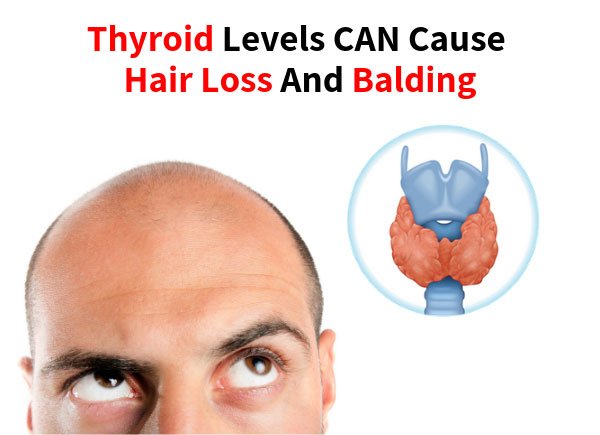 Thyroid Levels CAN Cause Hair Loss And Balding  Hair Loss ...