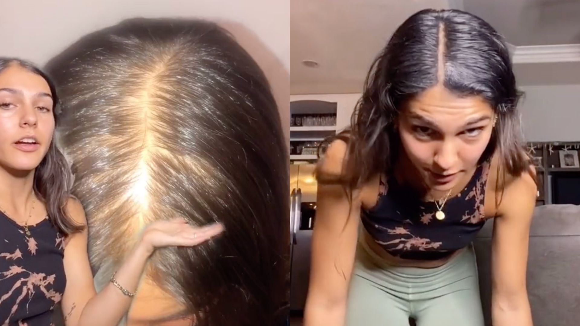 TikTok star used micoblading to cover baldness after birth ...