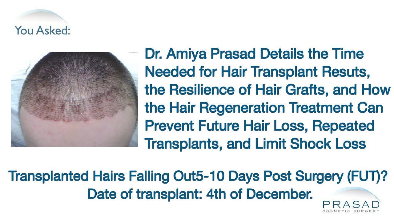 Time Needed for Hair Transplant Results, and How to Limit ...