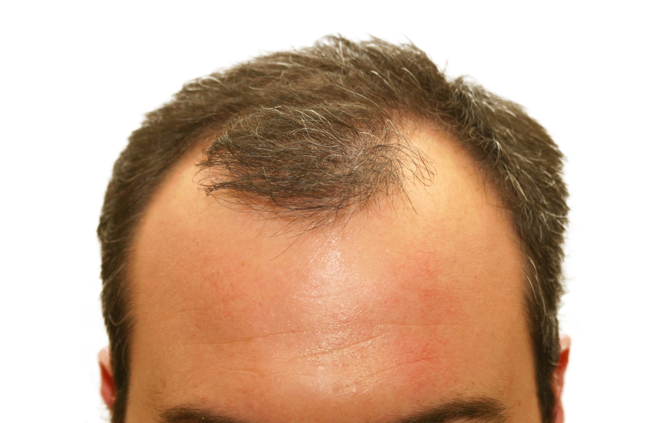 Top 5 Natural Hair Loss Treatment for Men