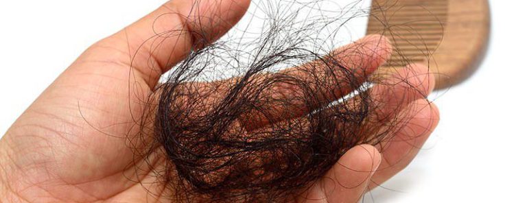 (Top 9) Causes Of Hair Loss In Women Over 50
