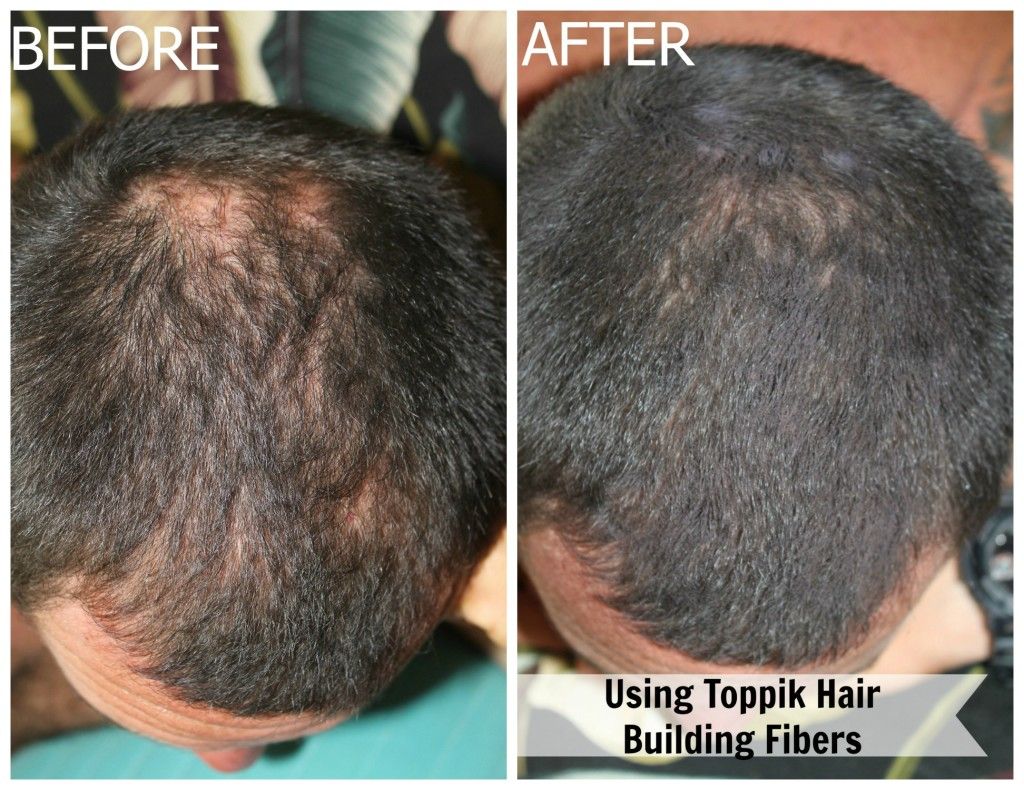 Toppik Hair Building Fibers for those dealing with Hair Loss! It Works ...
