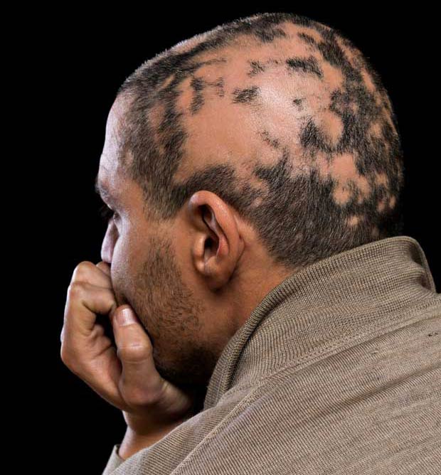 Types and Causes of Permanent Hair Loss