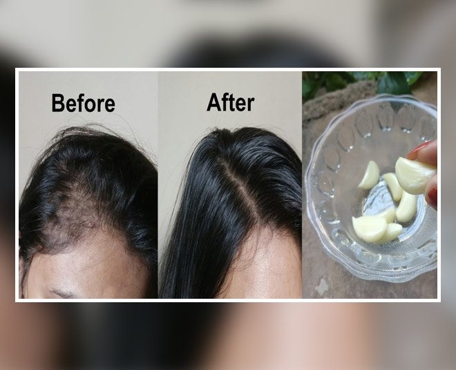 Use Garlic At Home To Prevent Hair Loss &  Dandruff
