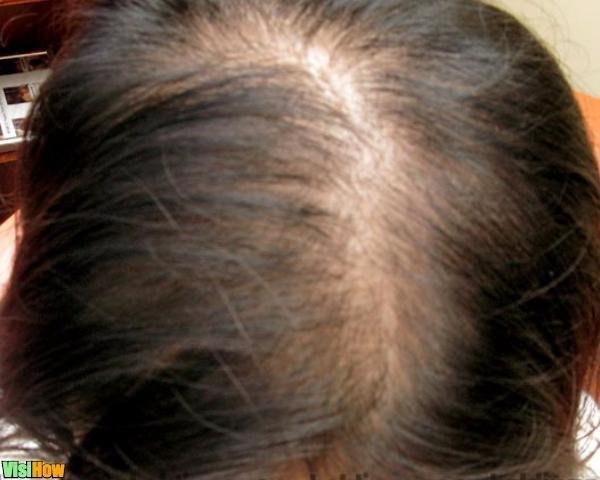 Use Homeopathic Remedies to Treat Hair Loss Due to Anemia ...