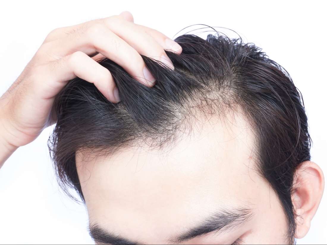 Vitamin D deficiency hair loss: Symptoms and treatment