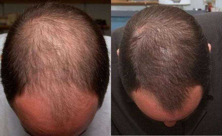 What can a dermatologist do about hair loss men and women ...