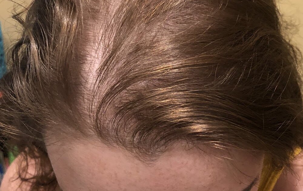 What Can I Do About Thinning Hair As A Woman