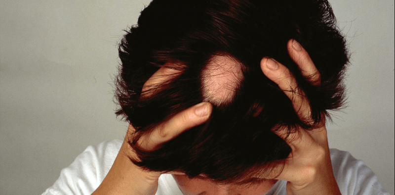 What causes alopecia areata and can you treat this type of ...