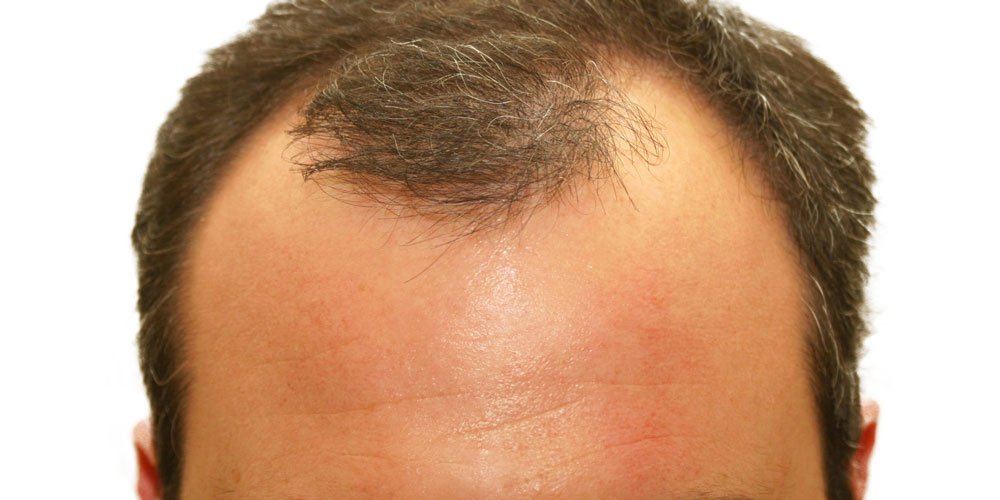 What Causes Sudden Hair Loss In Men : Sudden hair loss hits millions of ...