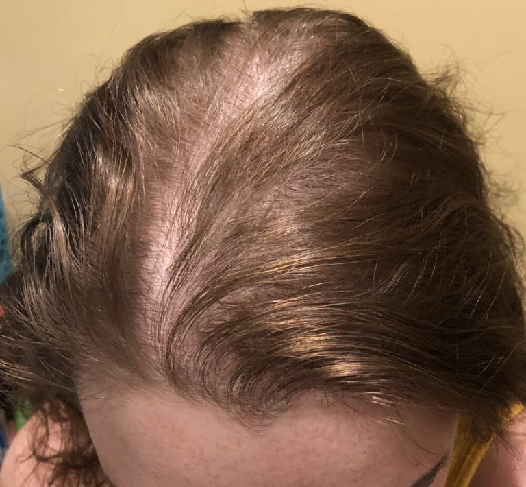 What Causes Thinning Hair? Thinning Hair Treatment