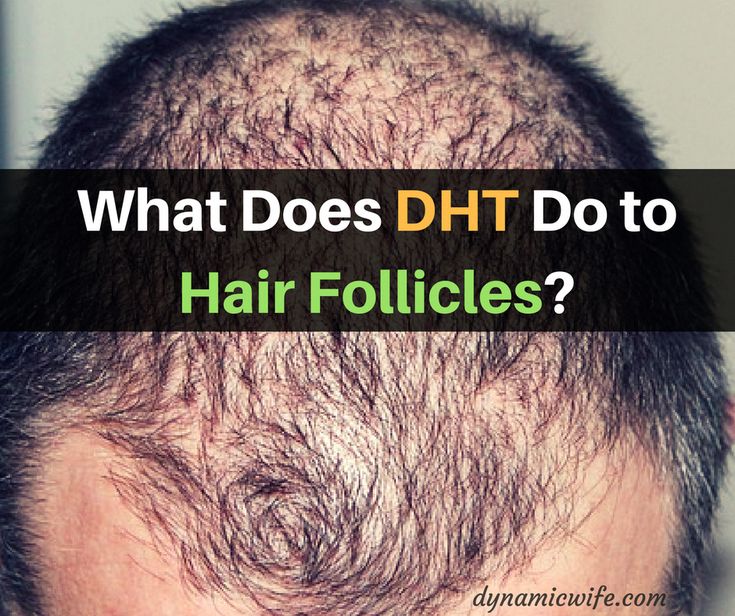 What Does DHT Do to Cause Hair Loss in Men? #thinninghairmen