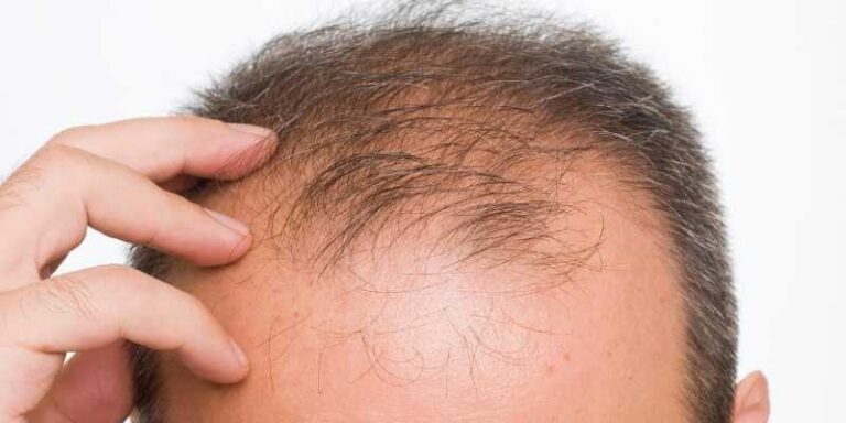 What does it mean when your Hair Falls Out Hair Loss Blog