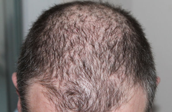 What is AGA Hair Loss? Androgenetic Alopecia