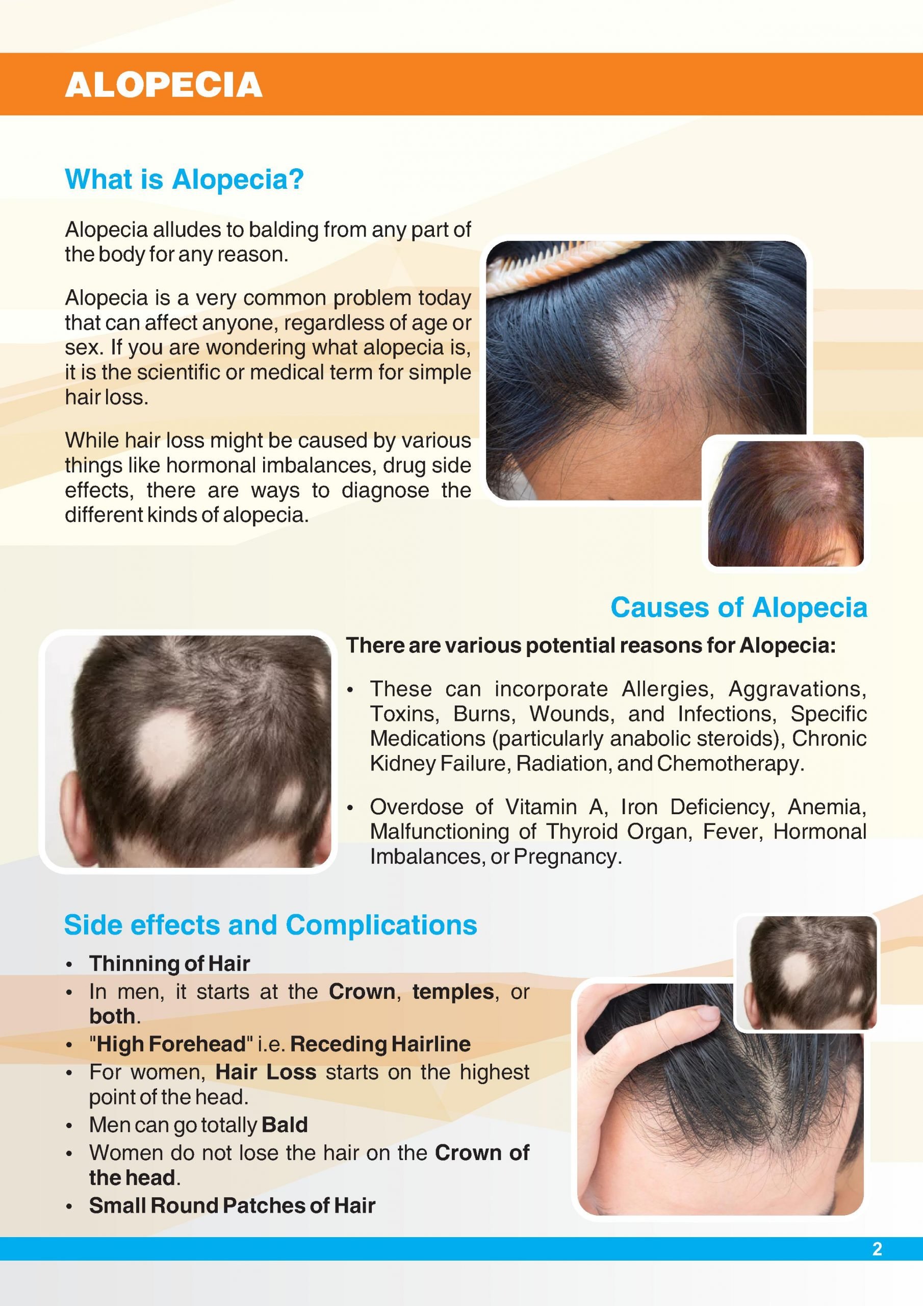 What is Alopecia Hair Loss