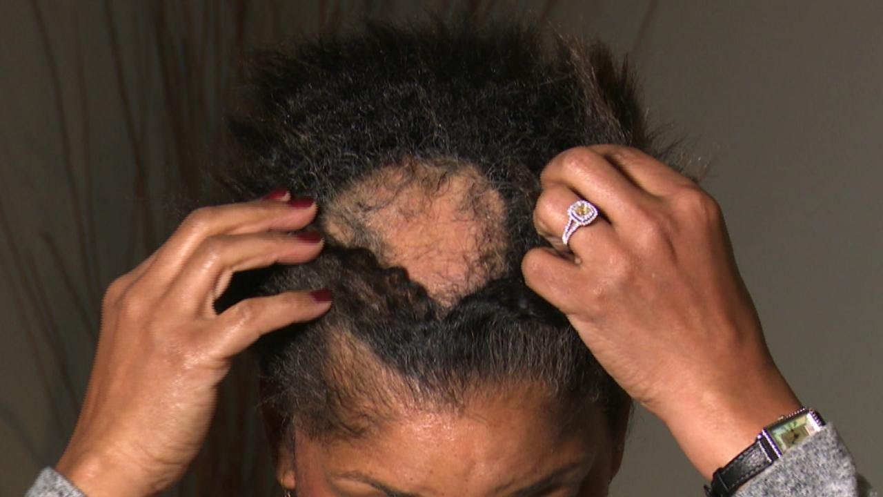 What Is Causing This Womans Extreme Hair Loss?