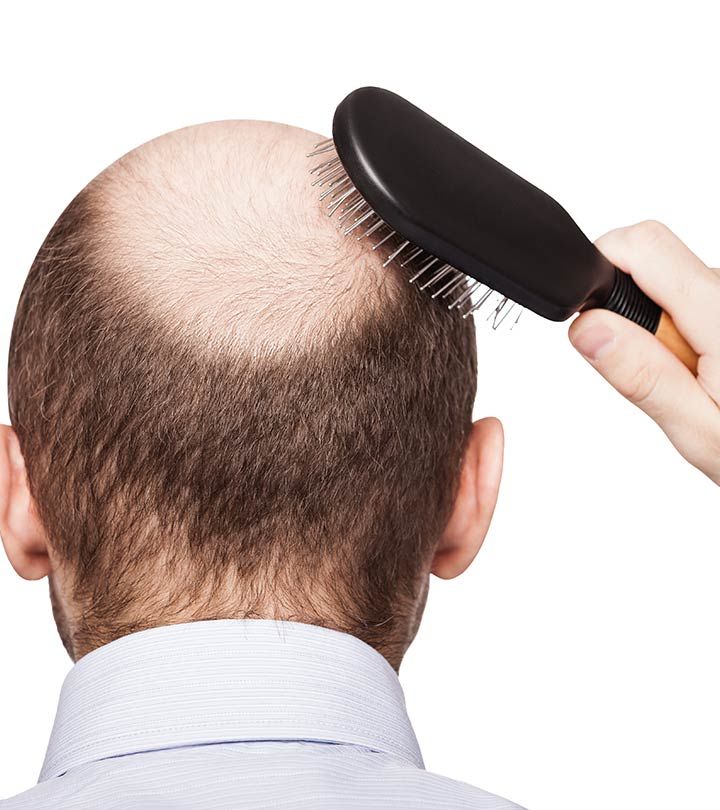 What Is DHT Hair Loss And How To Treat It?