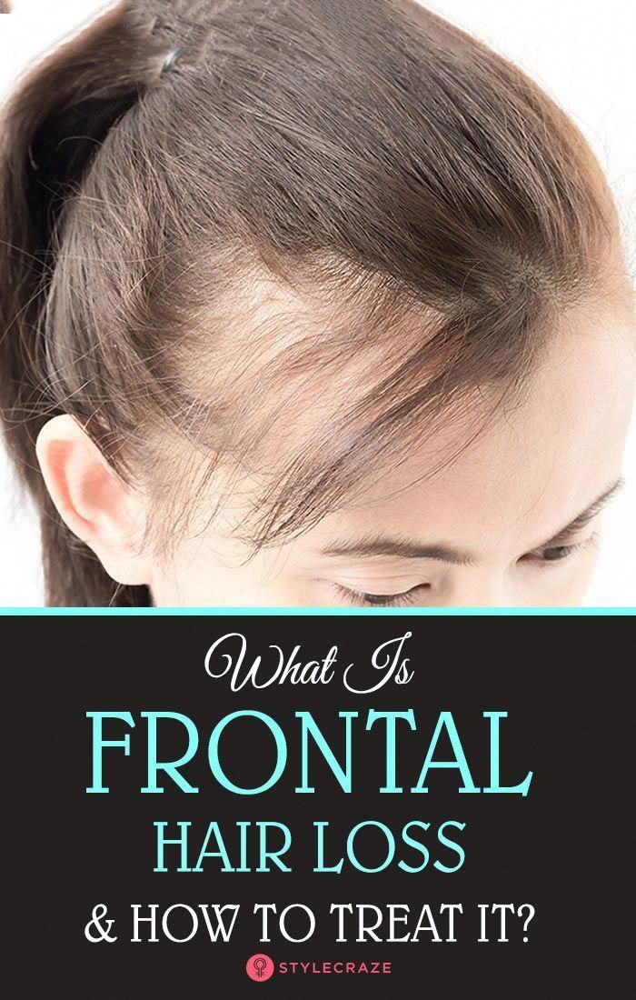 What Is Frontal Hair Loss And How To Treat It? #hairlosswomenremedies ...
