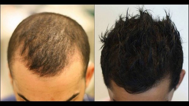What is PRP hair treatment, and how much does it cost?