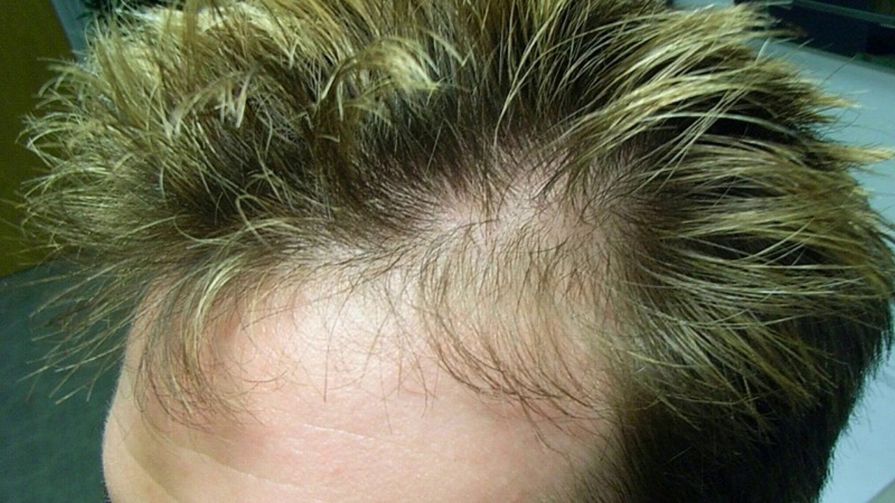 What Is The Cause Of Male Hair Loss