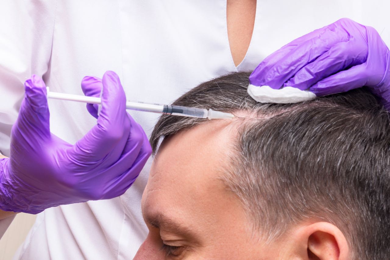 What Itâs Really Like To Get PRP Treatments For Male Hair Loss