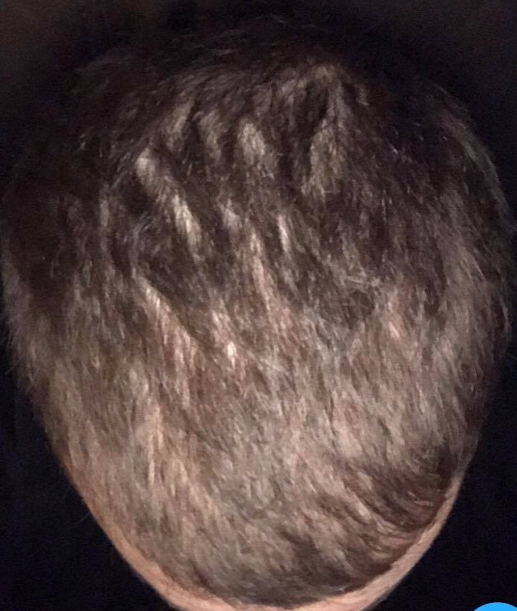 What kind of hair loss do I have (PIC INCLUDED) : tressless