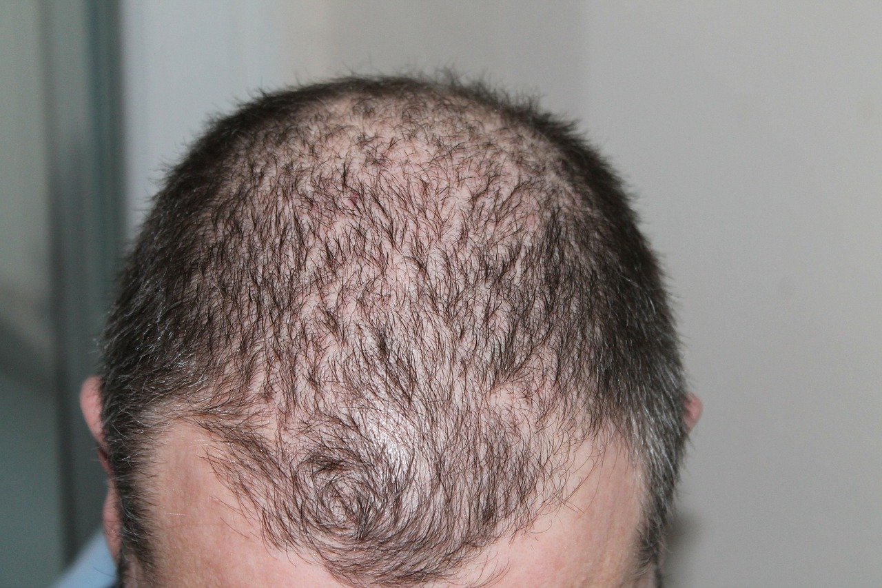 What Works For Hair Loss