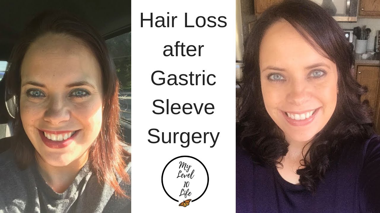 Why do you lose hair after gastric sleeve surgery ...