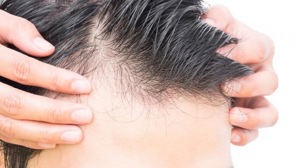 Why does hair loss happen?