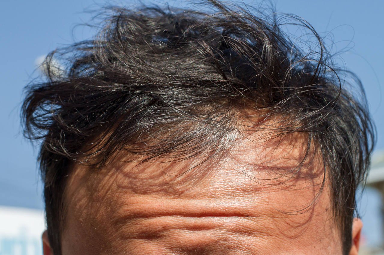 Why is my hair so thin and fragile ? Elithairtransplant